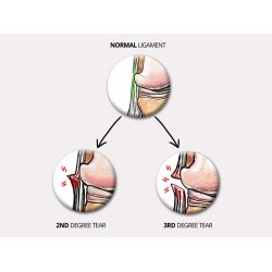 Knbandage OKD-23 til aktive ligamenter 